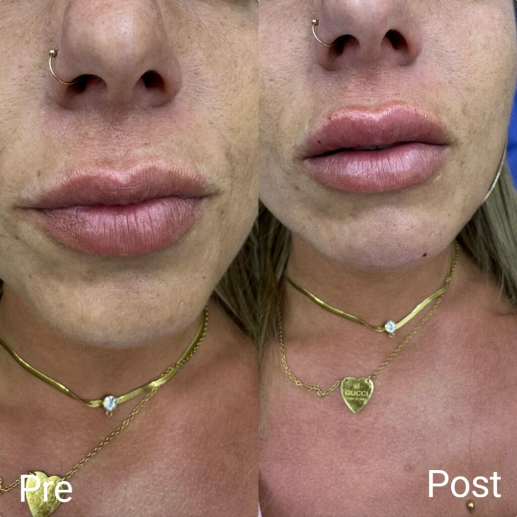 نفخ او تكبير الشفايف بالهيالورون